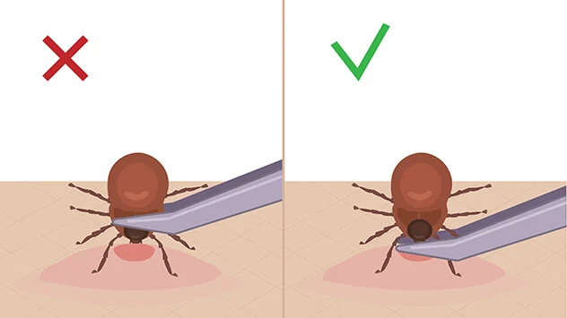 Infografik: So entfernen Sie Zecken richtig
