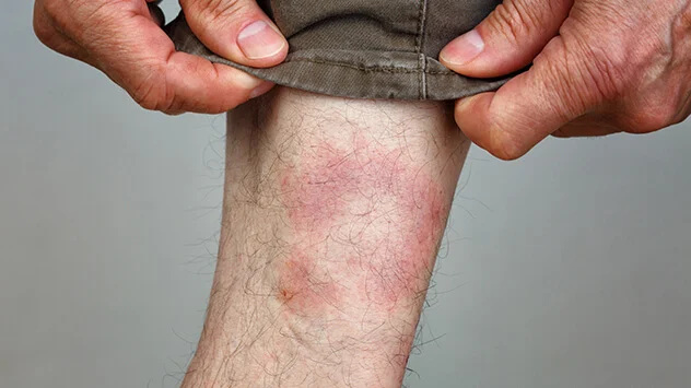 Zecken: Borreliose erkennen Gerötete Hautstelle nach Zeckenbiss