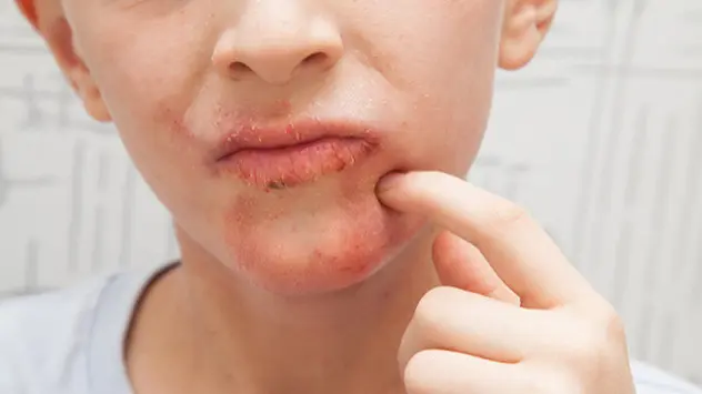 Allergische Reaktion in Mund und Rachen