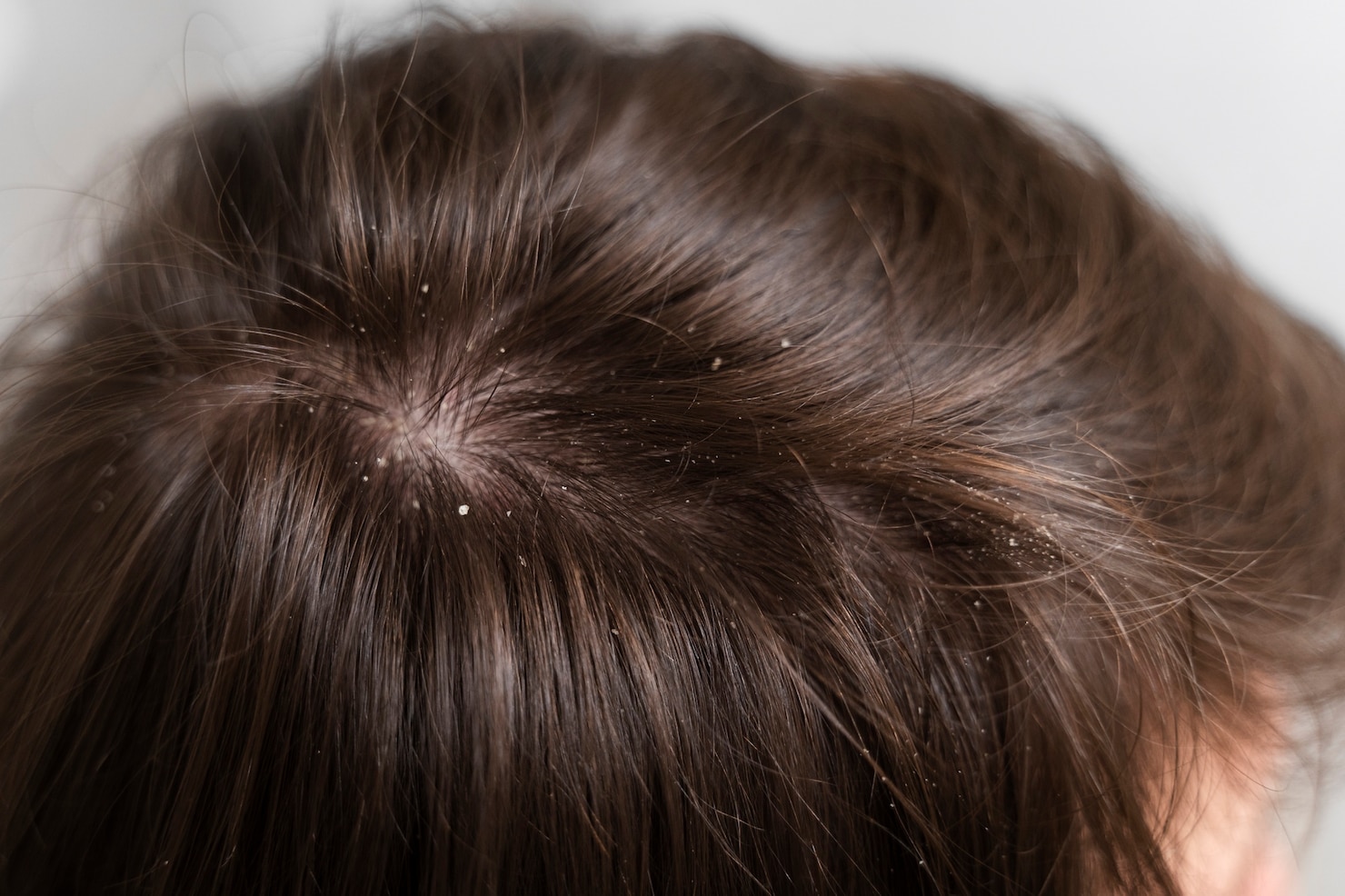 The Dandruff Dilemma: Does Dandruff Cause Hair Loss?