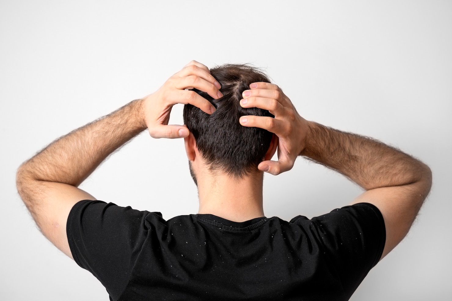 Exploring the Connection: Can Dandruff Lead to Hair Loss? 