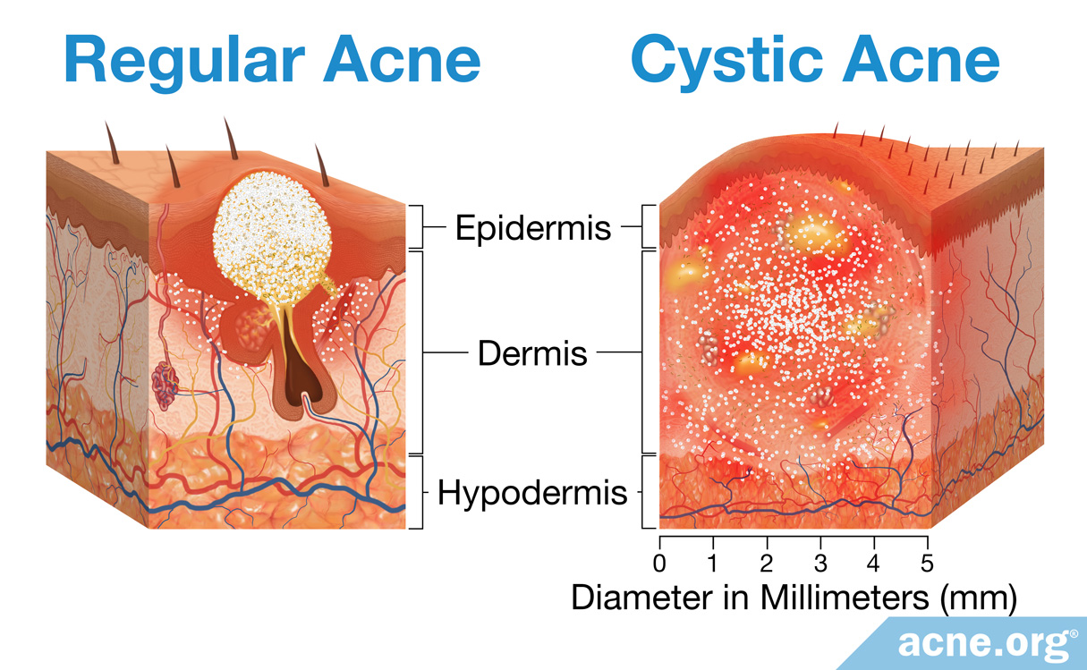 Regular-Acne-vs-Cystic-Acne-Whats-the-Difference