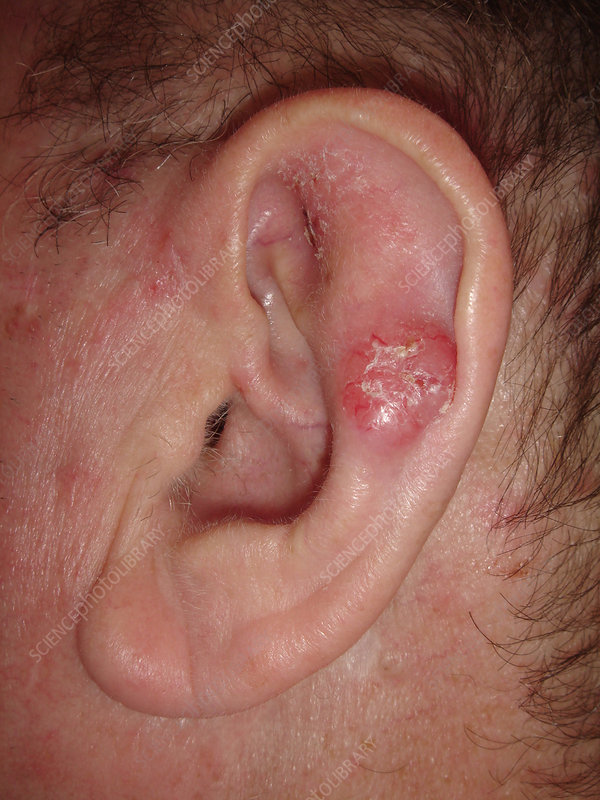 C0473523-Basal cell carcinoma