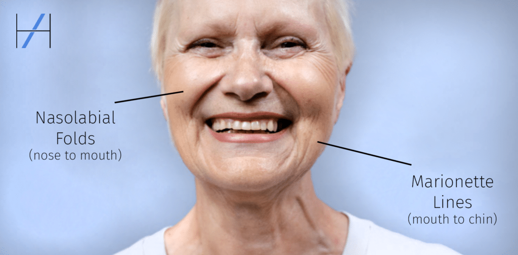 Marionette-Lines-and-Nasolabial-Folds-Facial-Rejuvenation-Injectables-Advice-Harley-Academy-Aesthetic-Medicine-Training-Courses-Dermal-Filler-1024x504