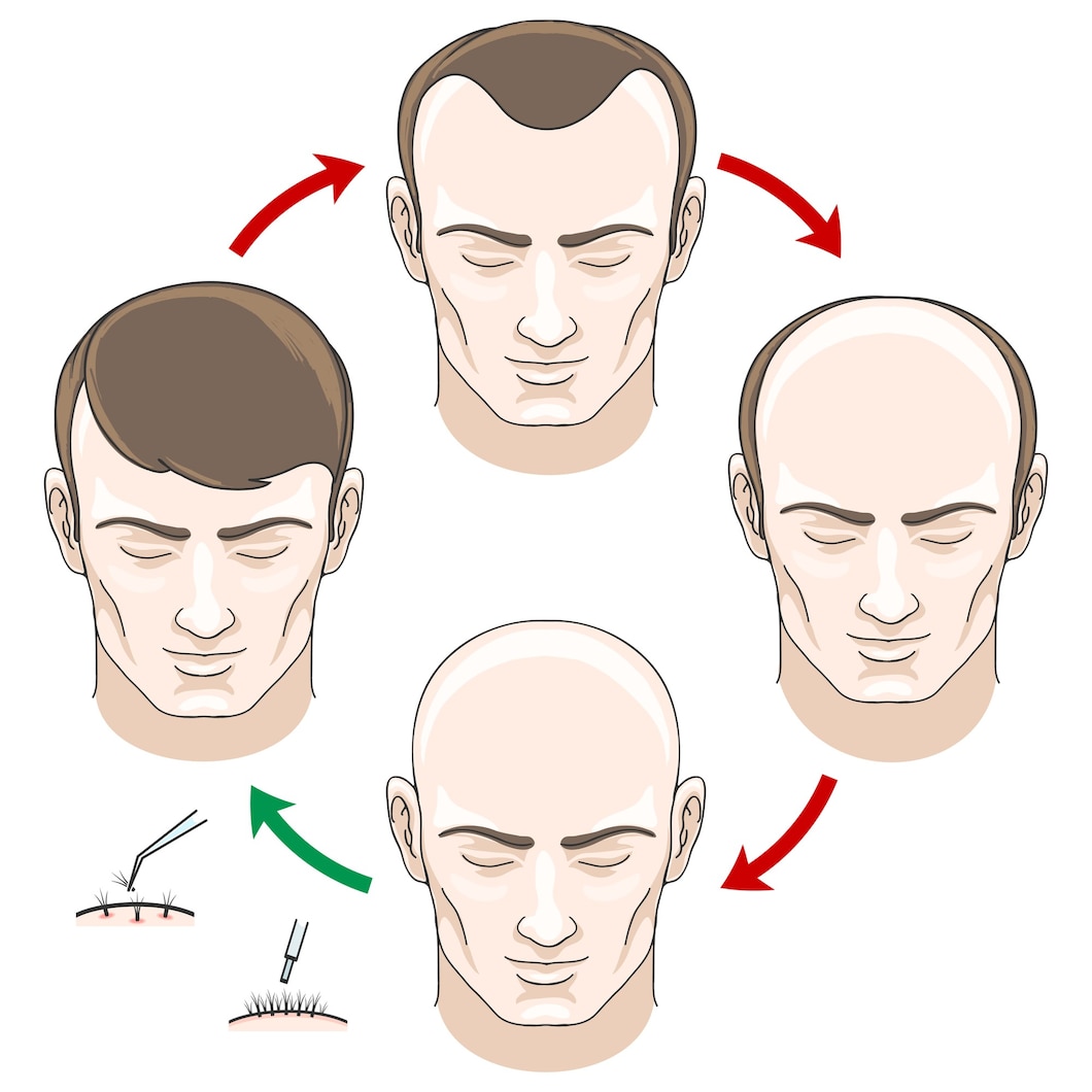 From Onset to Advanced: Mapping Out Receding Hairline Stages