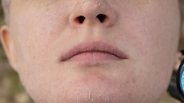 Overnight Solutions: How to Get Rid of Dry Skin around the Mouth