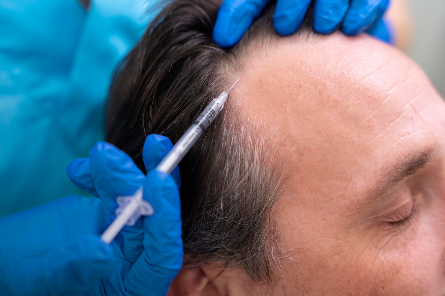 Microneedling For Hair Loss: How To Combat Thinning Hair