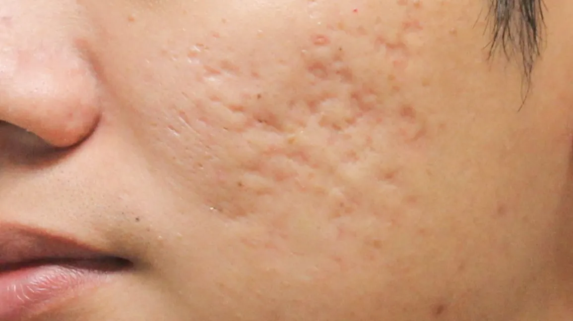 Acne-Boxcar-Scar-face-1296x728-body-1-1296x728