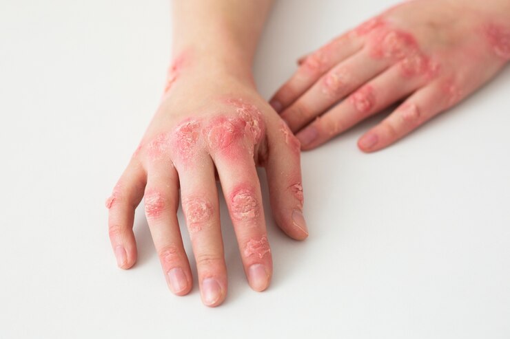 Eczema vs Dry Skin: Understanding the Differences and Similarities