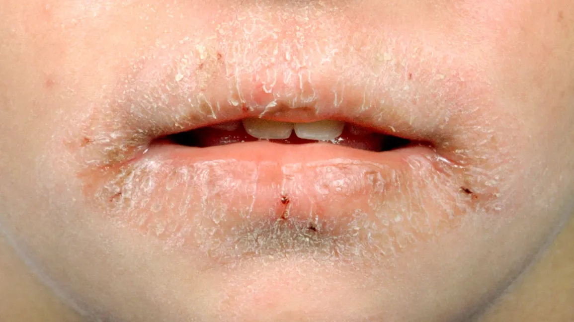 Lip-lickers-dermatitis-1296x728-slide1