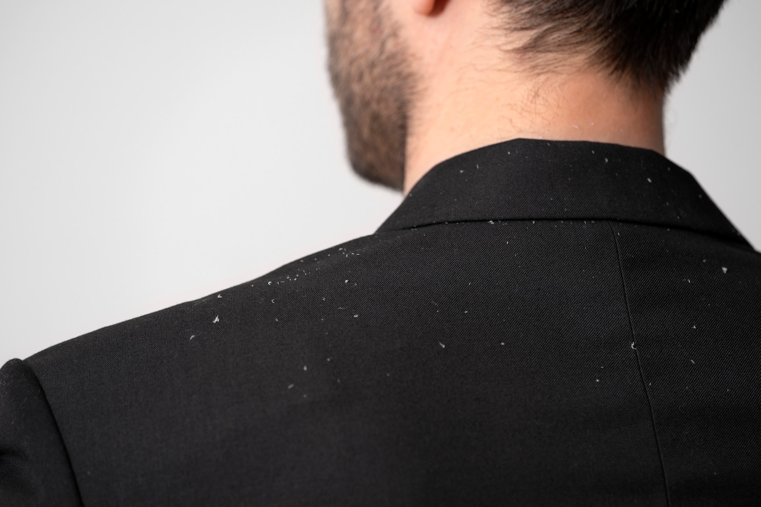 Unraveling The Truth: Is Dandruff Contagious Or Misunderstood?