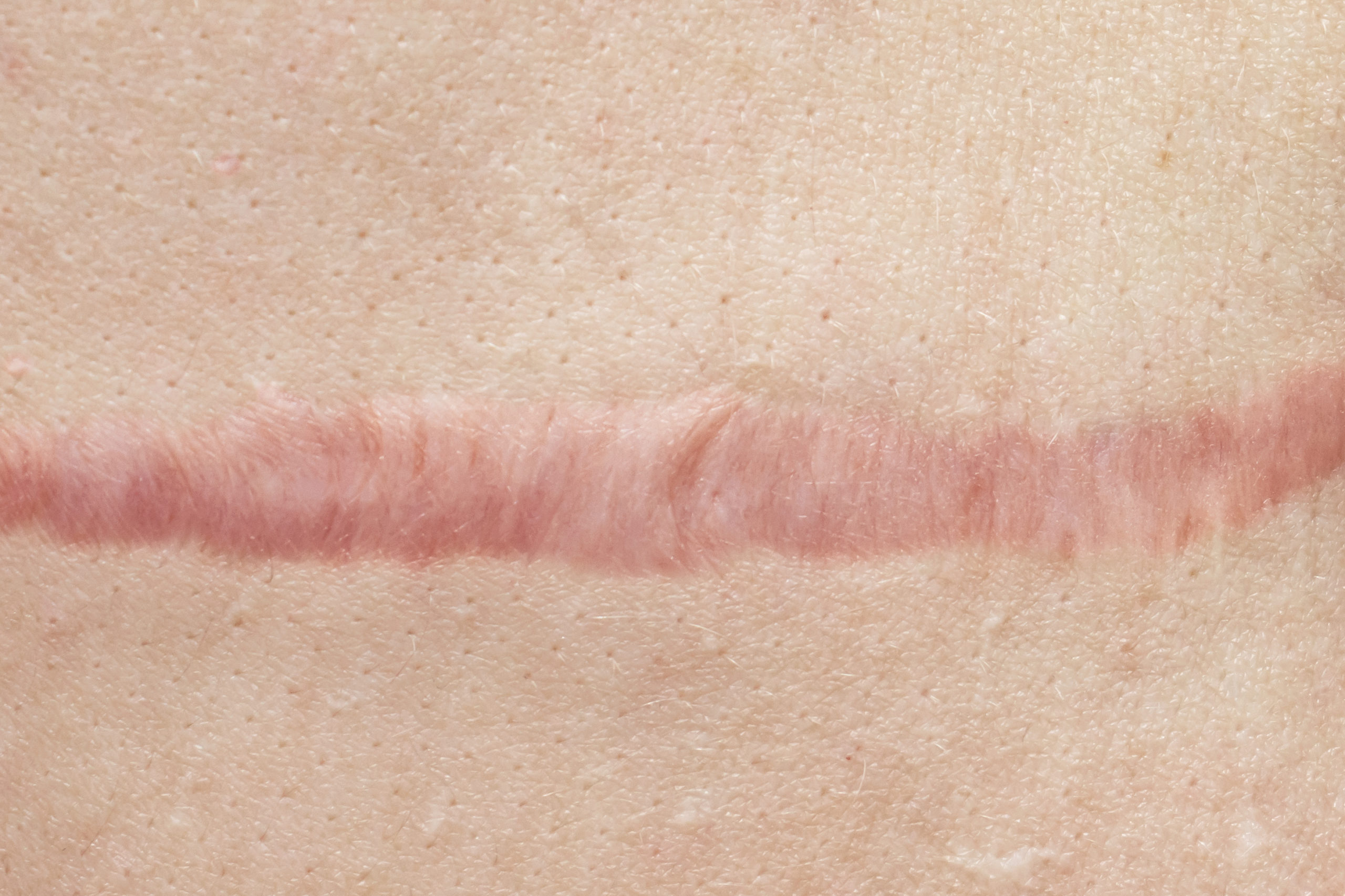 Hypertrophic Scar GettyImages-1142492665-scaled