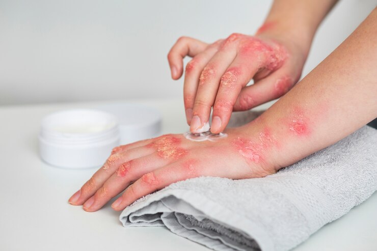 hands-patient-suffering-from-psoriasis 23-2149329640