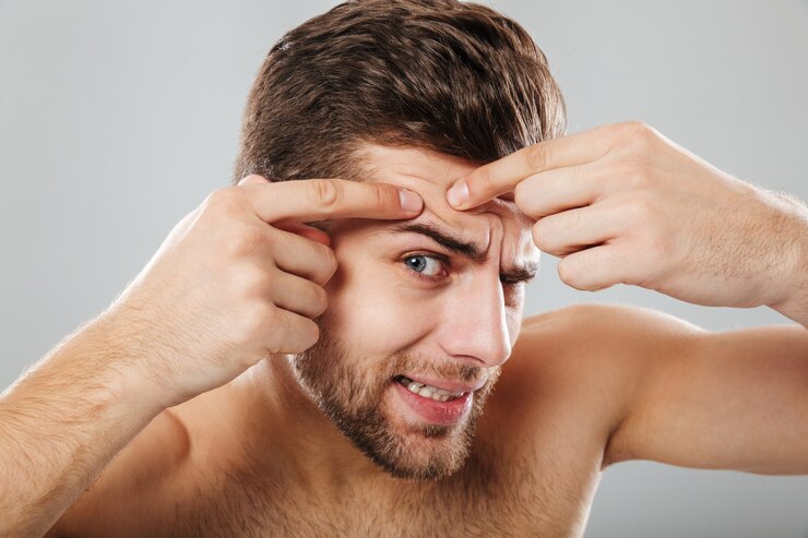 close-up-portrait-man-squeezing-pimple 171337-2905