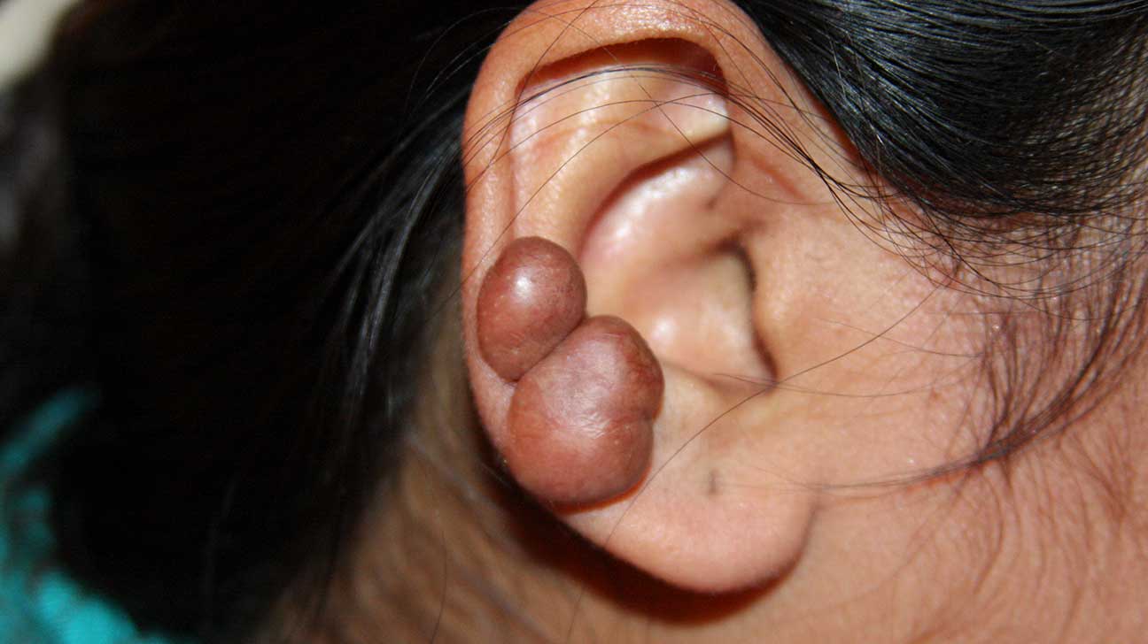 Keloid on ear-1296x728-slide1