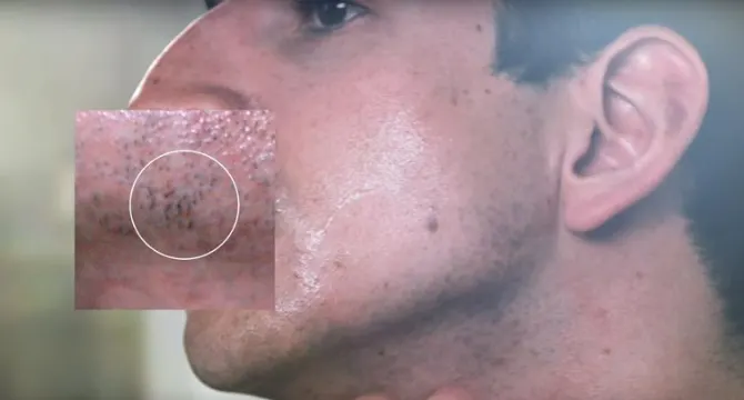 Vedi ancora peli casuali dopo una rasatura precisa, sciacqua il viso e asciugalo tamponando