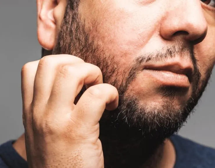 Prurito della barba: Cause, Prevenzione e Consigli per la Cura  