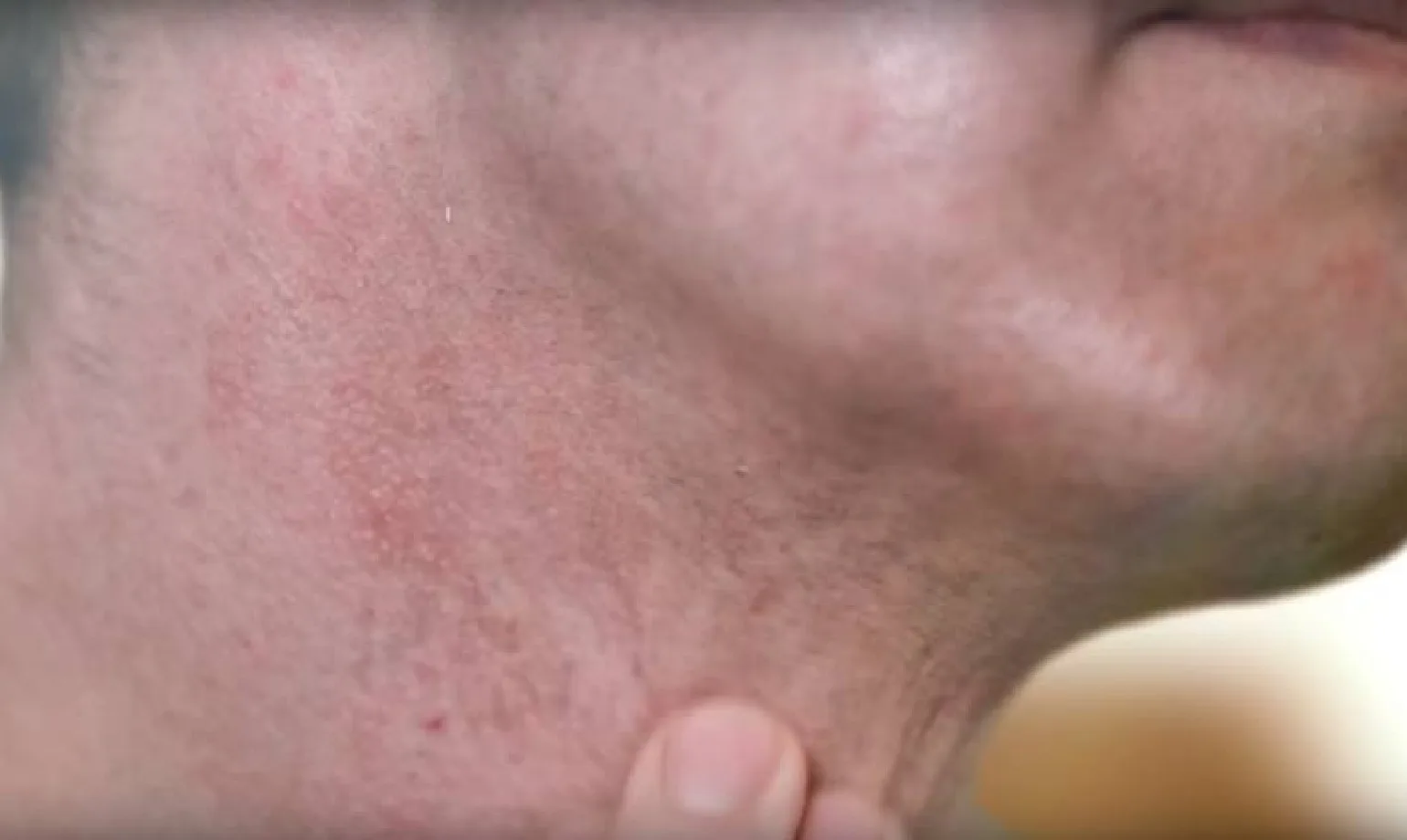 Irritation de la peau après le rasage