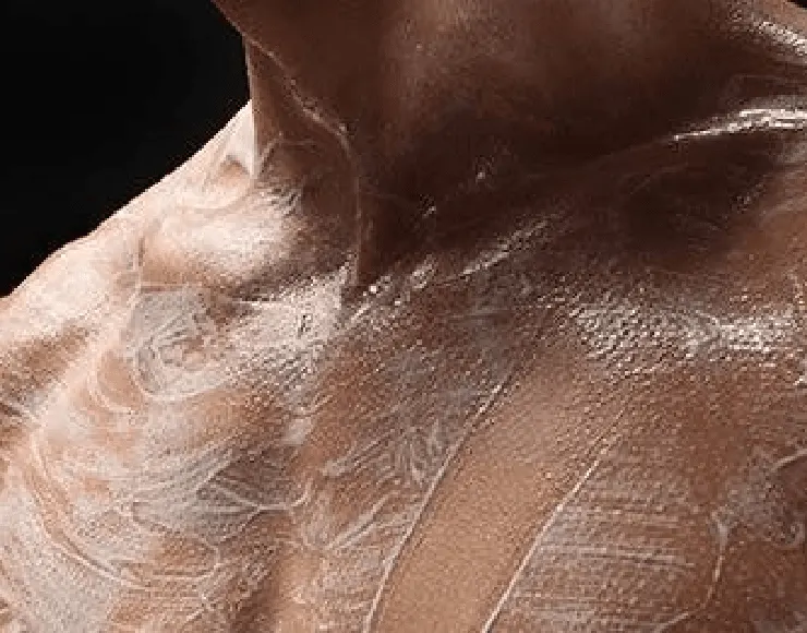 acne prone skin