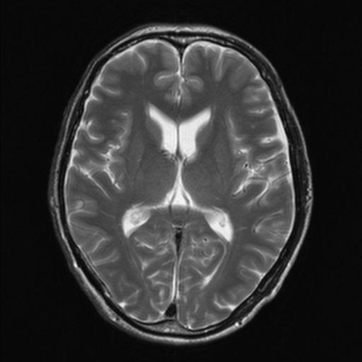 60代の脳のMRI画像
