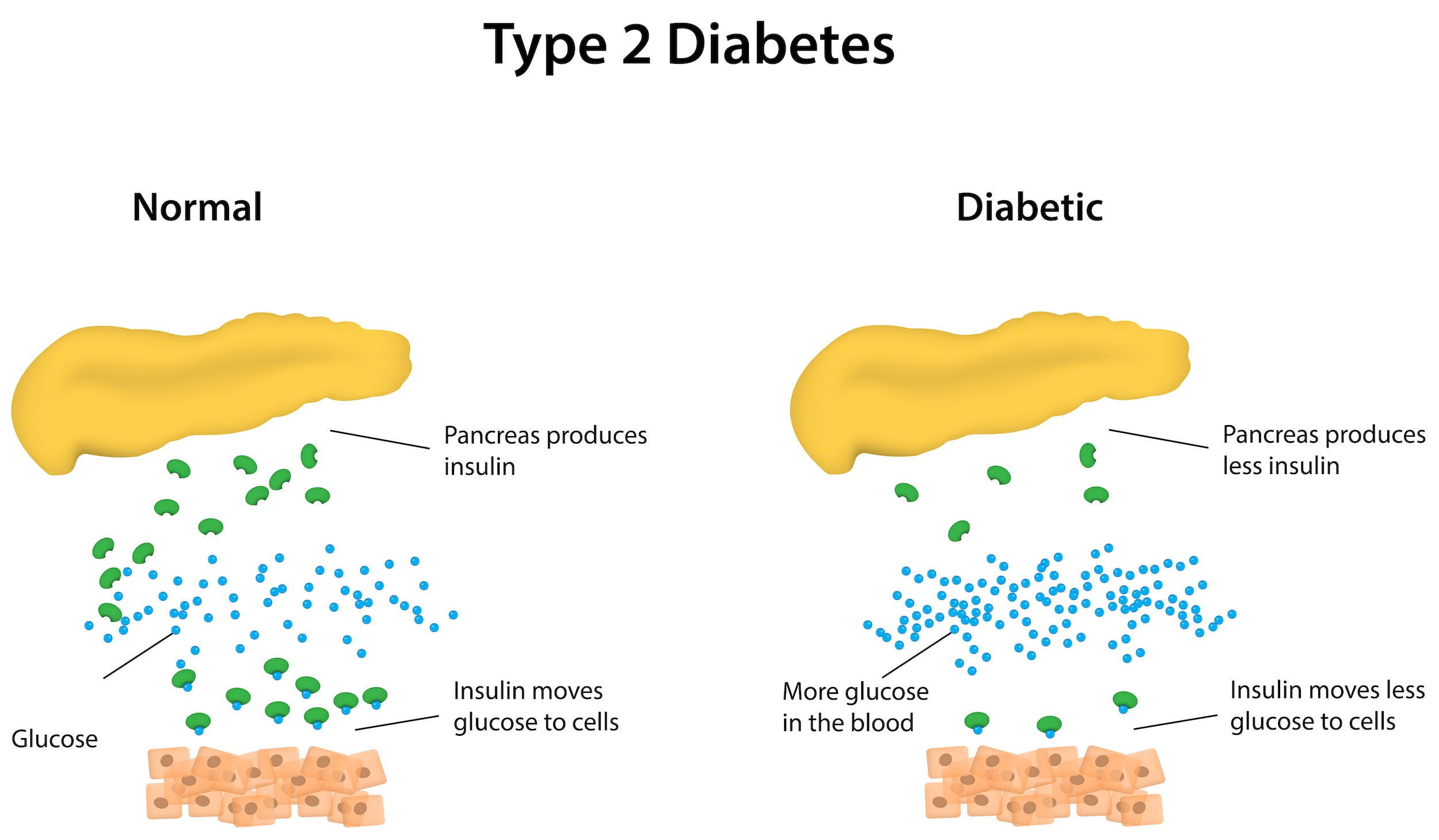 in type 2 diabetes, the pancreas produces less insulin which results in less glucose moving from the blood stream into the cells