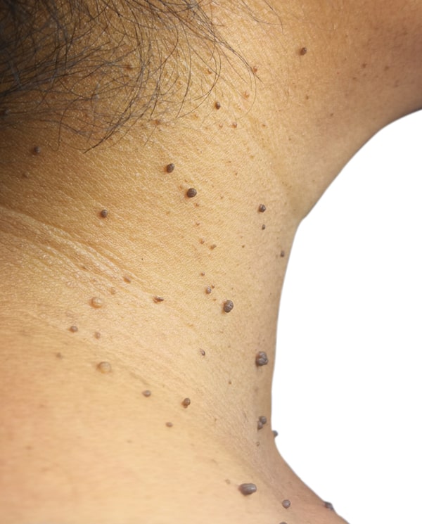 Example 1 - Skin tags