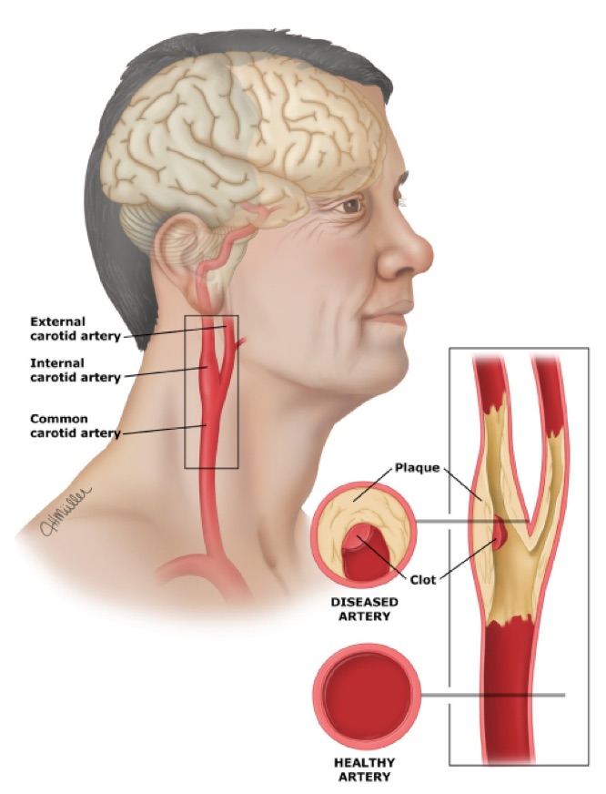 Cerebrovascular disease is a macrovascular complication in type 2 diabetes
