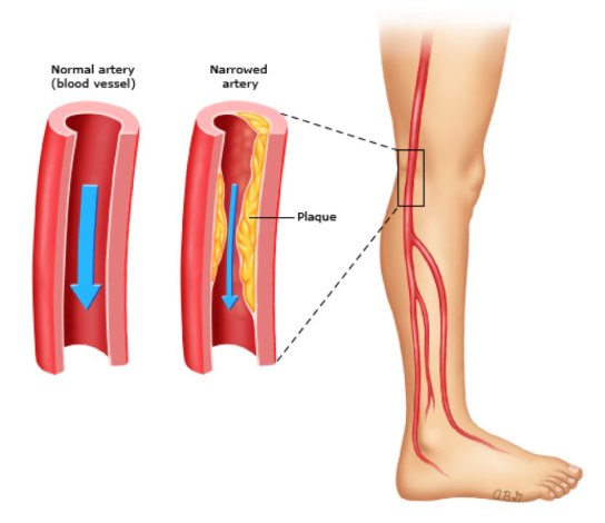 Peripheral artery disease is a macrovascular complication of type 2 diabetes