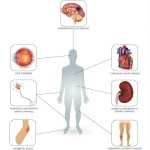 complications of diabetes infographic