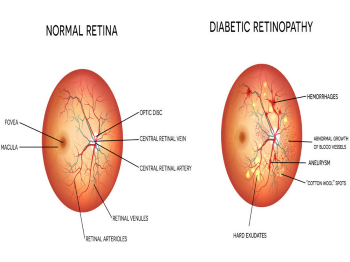 Diabetic retinopathy is a microvascular complication of type 2 diabetes