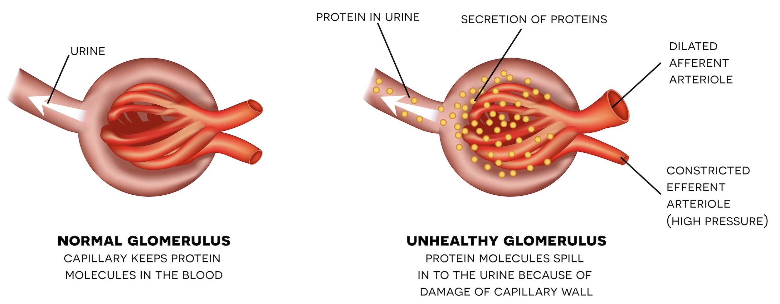 Diabetic nephropathy is a microvascular complication of type 2 diabetes