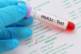 Hb A1c test shows the average amount of glucose bound to red blood cells in people with diabetes