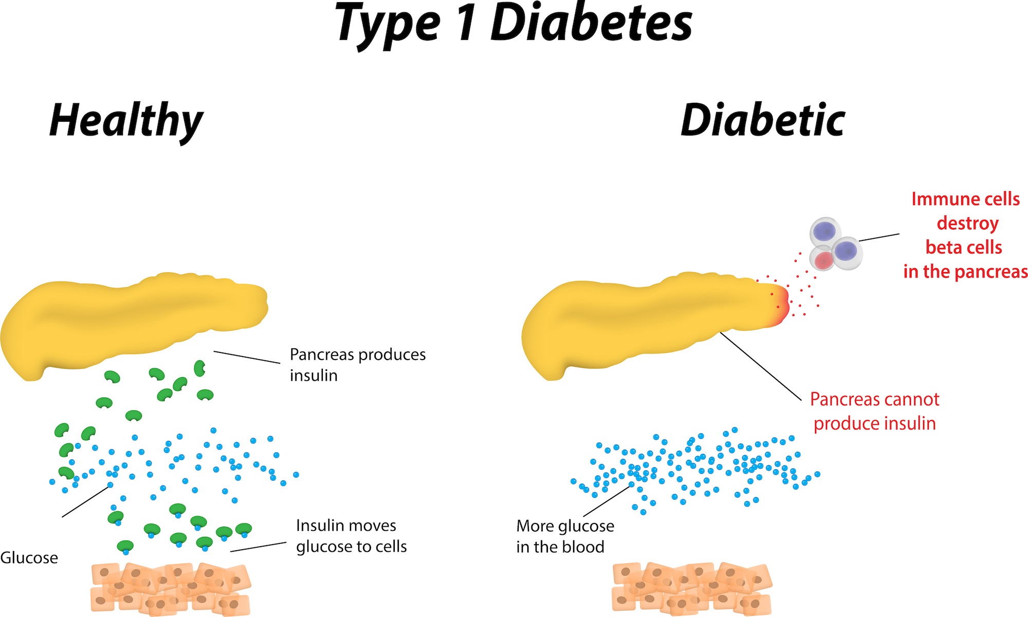People who have type 1 diabetes mellitus do not produce insulin