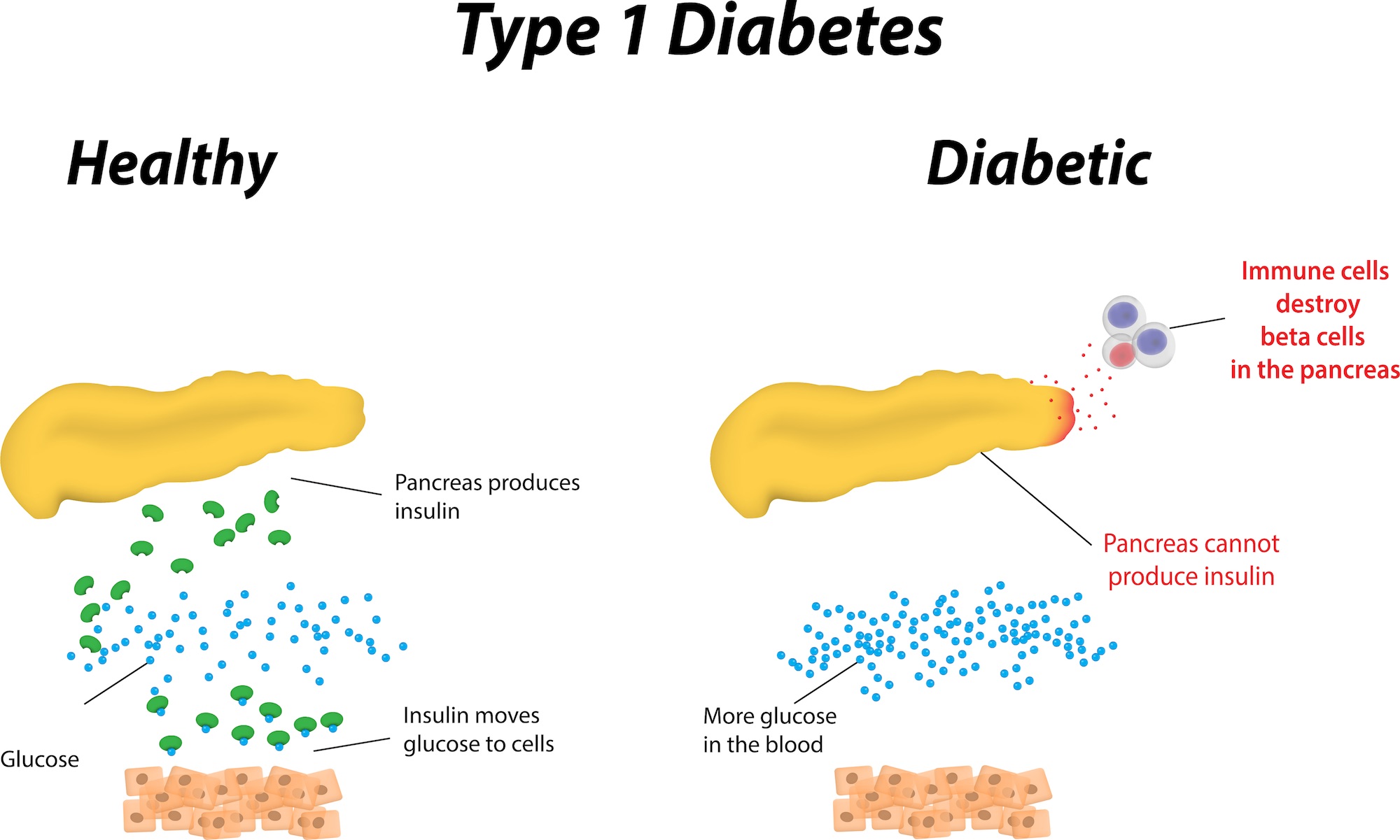 insulin diabetes type 1