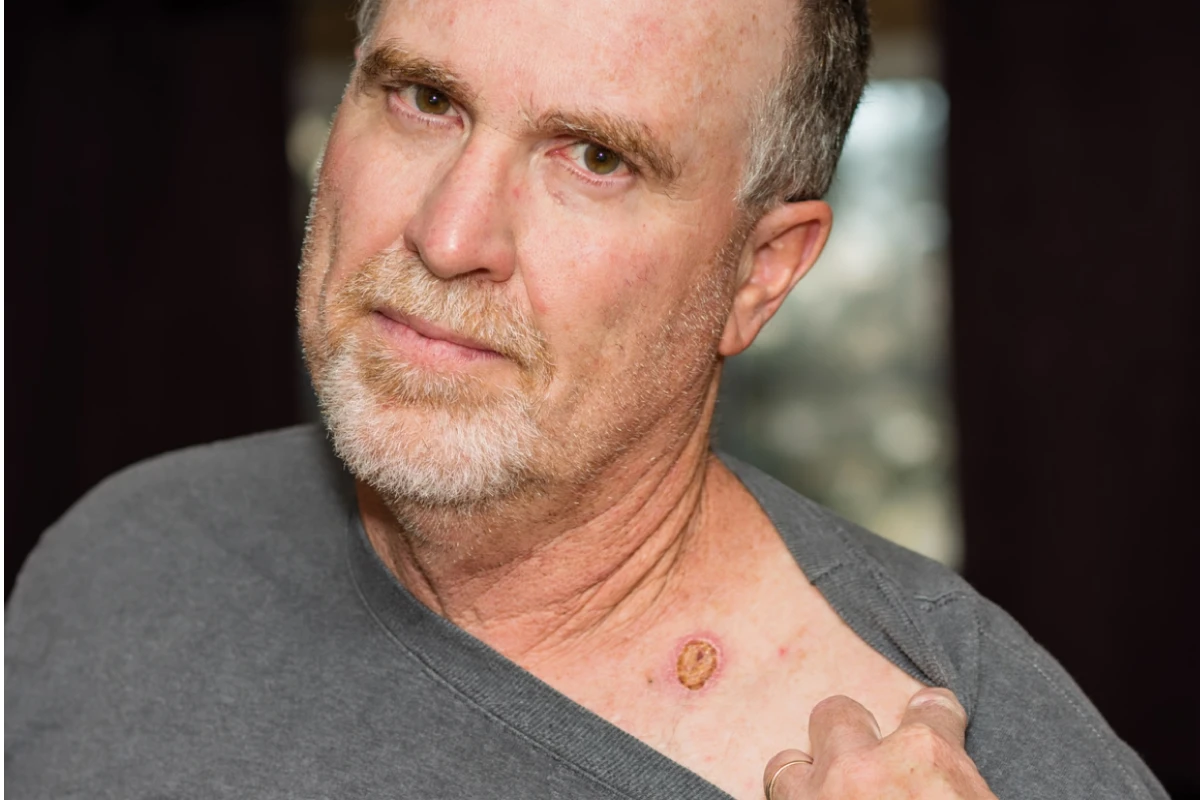 Does trauma cover include skin cancer for Aussies?