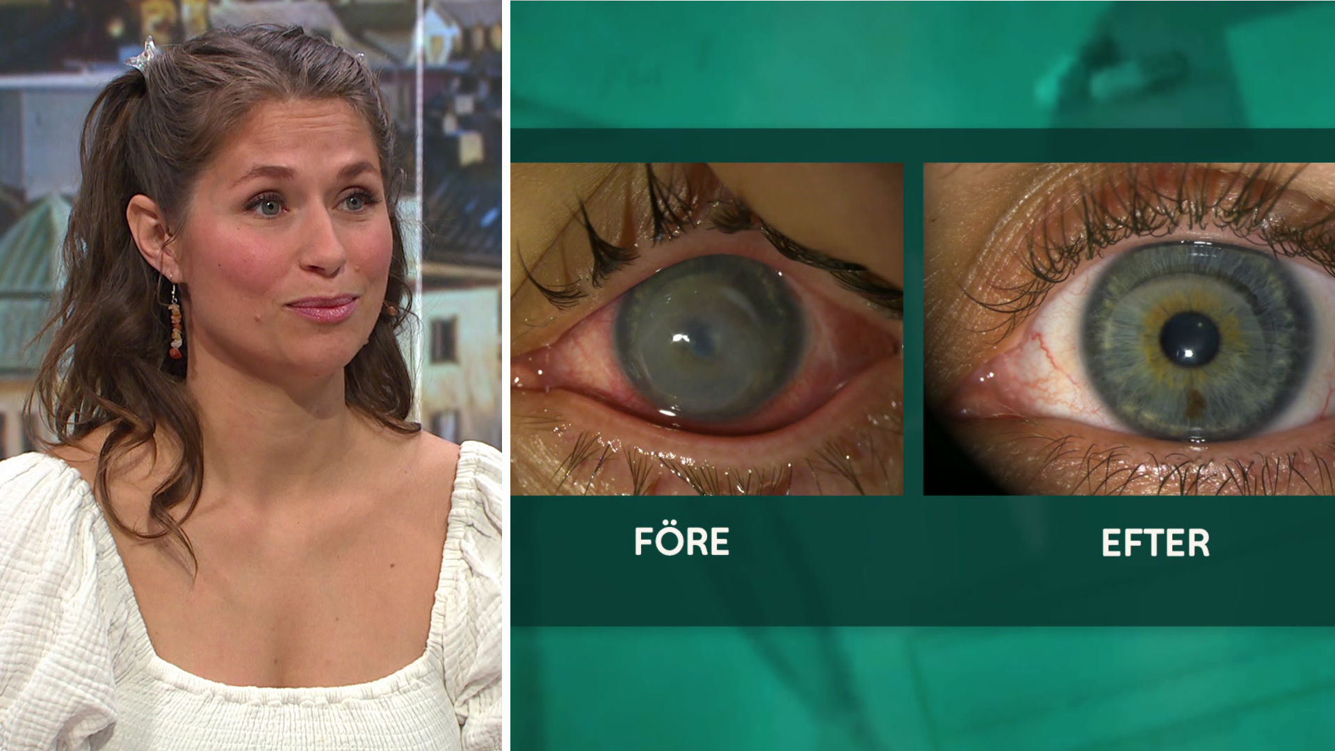 Emelies syn räddades av fosterhinna från gravid kvinna