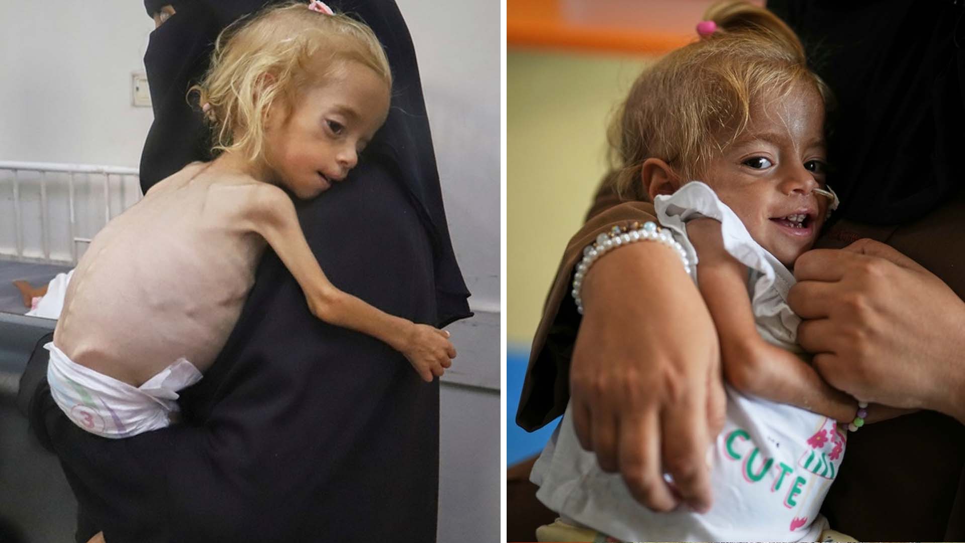 Tvååriga Shamm från Gaza fick nytt liv i Italien
