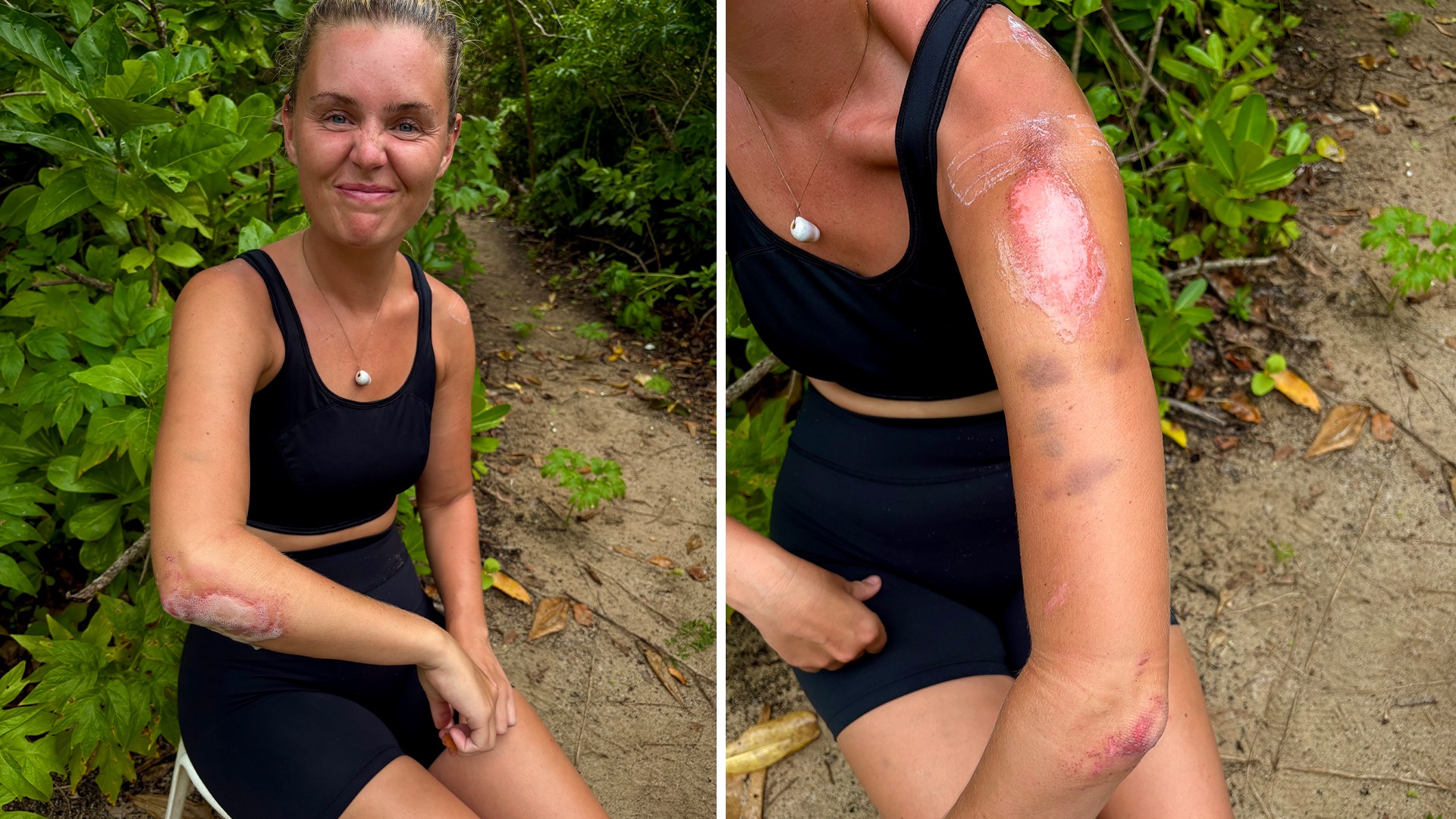 Därför tvingas flera bära bandage – Sonja om smärtan: ”Otroligt”