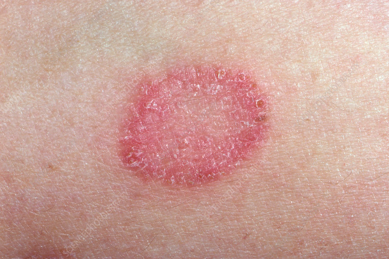 Ringworm fungal infection