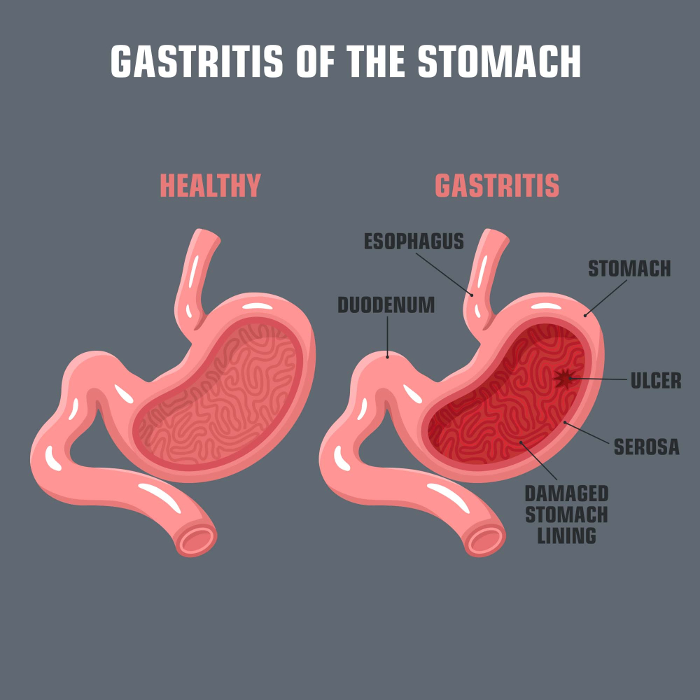 gastritis-of-the-stomach
