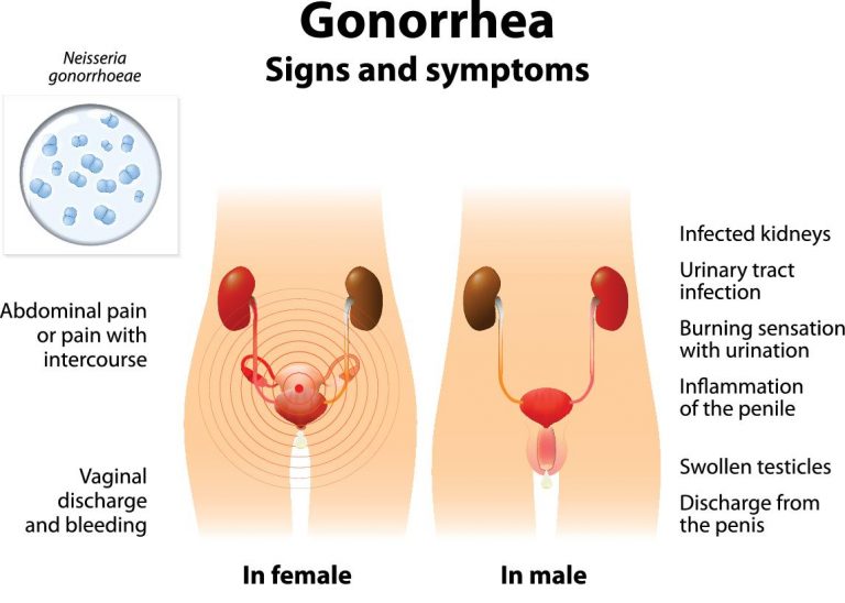 gonorrhea 