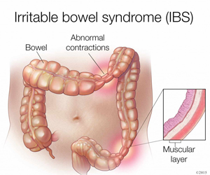 Irritable Bowel syndrome