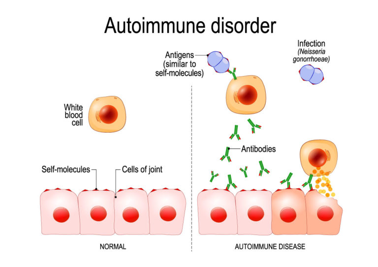 Autoimmune Disorder