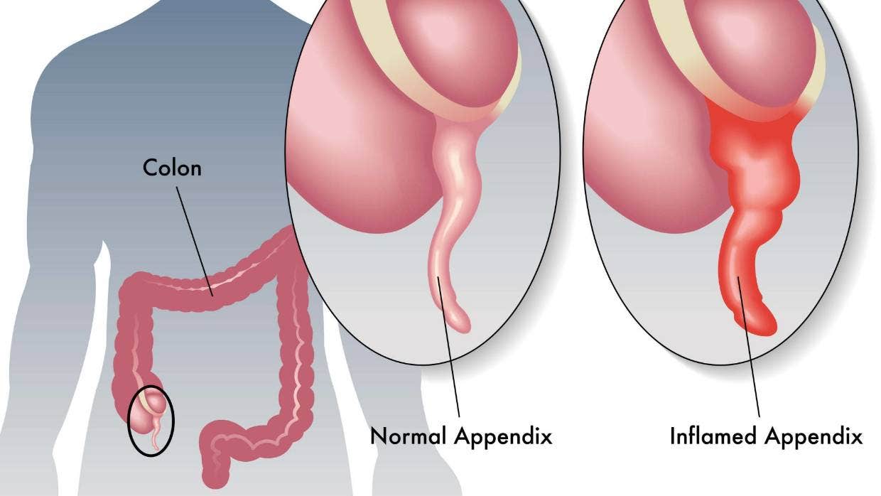 appendicitis