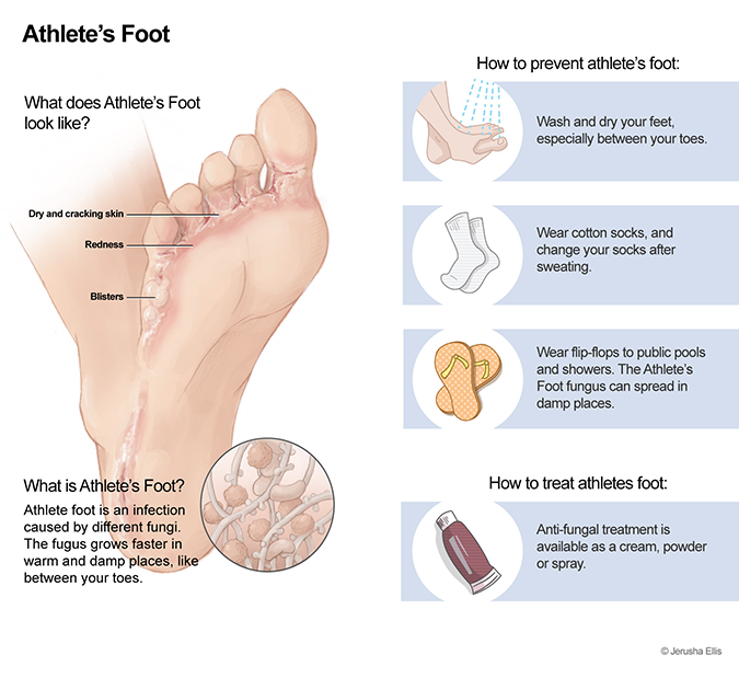 athletes foot