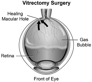 Post-Operative Positioning After Vitrectomy Surgery