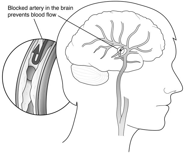 TIA (Transient Ischemic Attack): Symptoms & Treatment