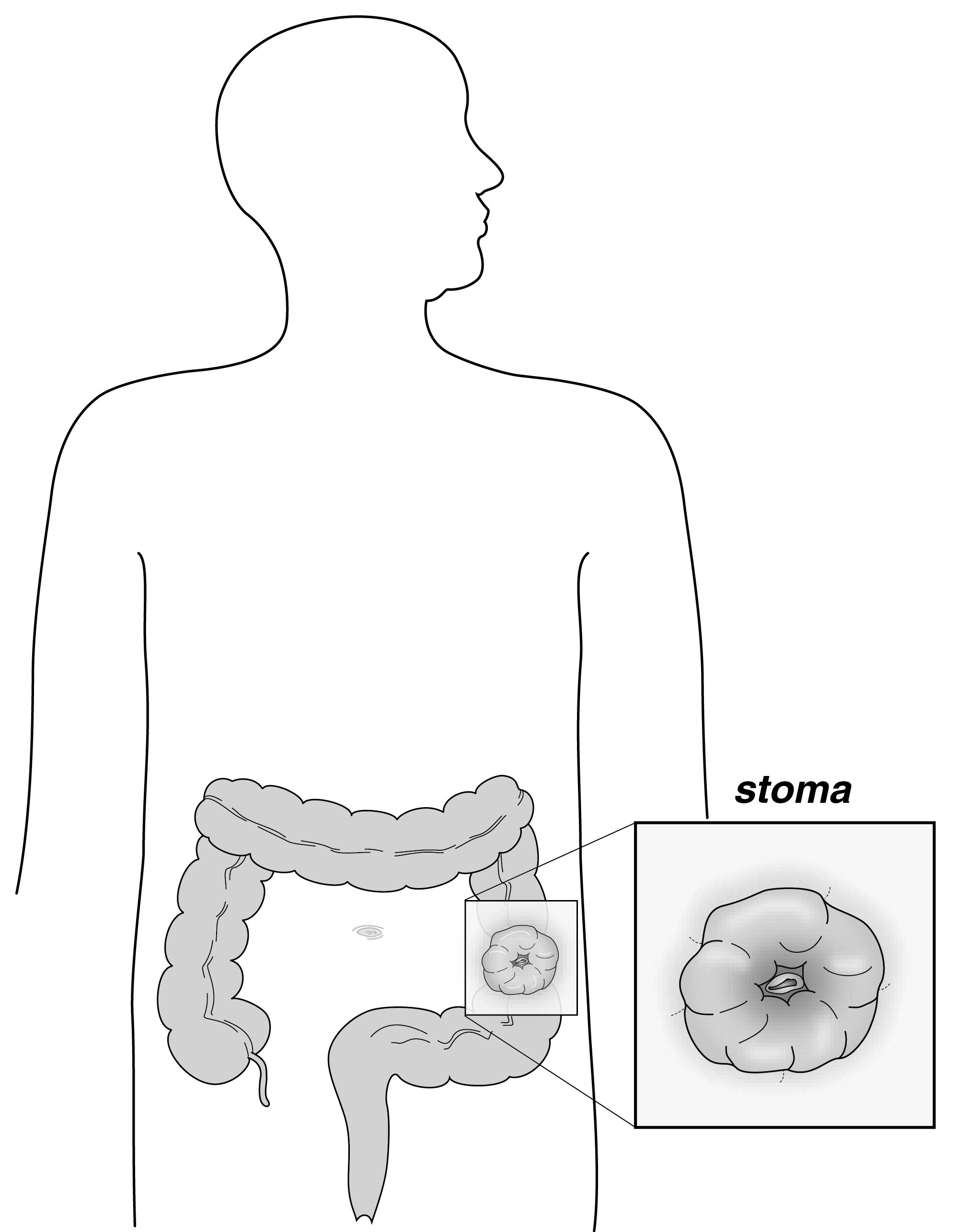 Ileostomy Pouch (Pediatric)