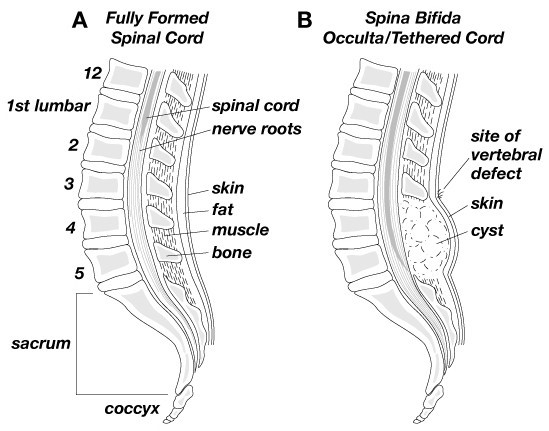 Hair Tuft Of Tethered Cord