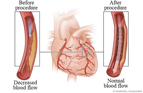 Healthwise Stent Image